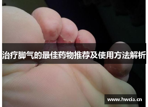 治疗脚气的最佳药物推荐及使用方法解析 治疗脚气的最佳药物推荐及使用方法解析